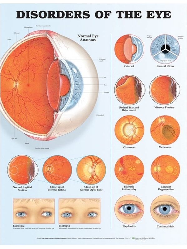 Disorder of the Eye Chart (52x70cm) With Special Rigid Lamination and Plastic Rollers