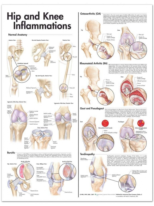 Hip and Knee Inflammations Chart (52x70cm) With Special Rigid Lamination and Plastic Rollers