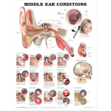 Middle Ear Condition Chart (52x70cm) With Special Rigid Lamination and Plastic Rollers