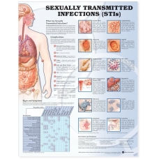 Sexually Transmitted Infections Chart (52x70cm) With Special Rigid Lamination and Plastic Rollers