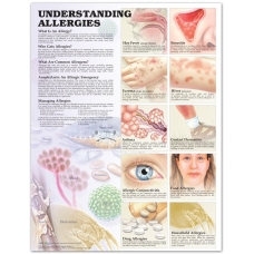 Understanding Allergies Chart (52x70cm) With Special Rigid Lamination and Plastic Rollers