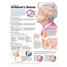 Understanding Alzheimer's Chart (52x70cm) With Special Rigid Lamination and Plastic Rollers