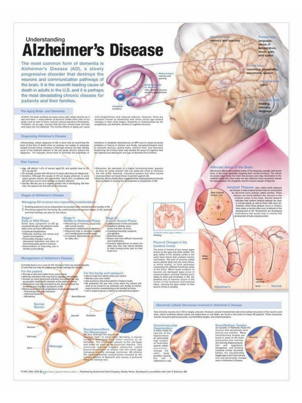 Understanding Alzheimer's Chart (52x70cm) With Special Rigid Lamination and Plastic Rollers