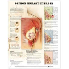 Understanding Breast Disease Chart (52x70cm) With Special Rigid Lamination and Plastic Rollers