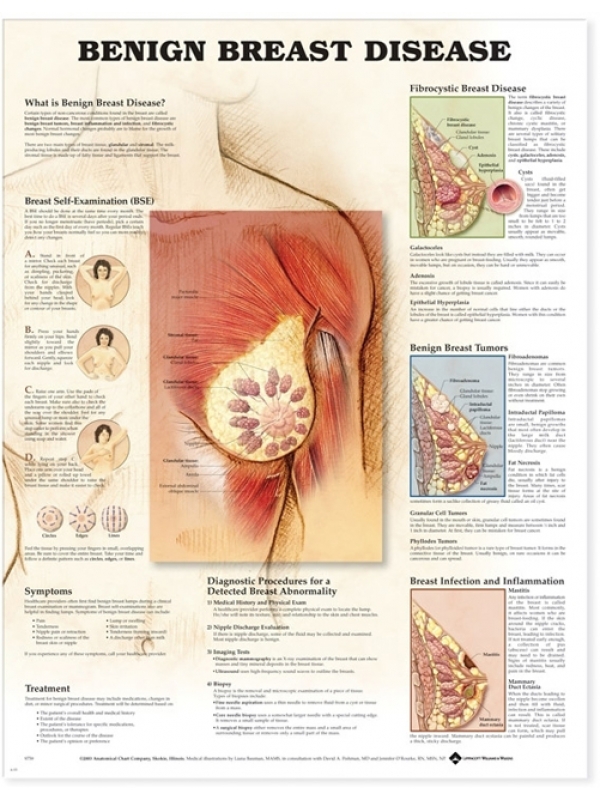 Understanding Breast Disease Chart (52x70cm) With Special Rigid Lamination and Plastic Rollers