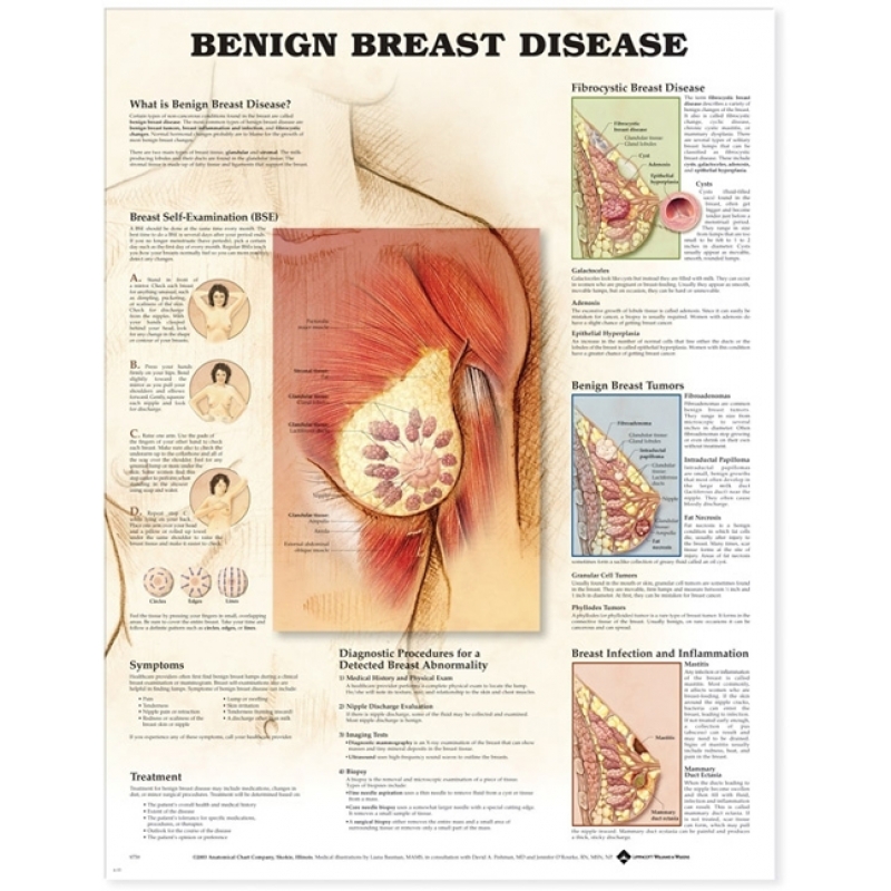 Understanding Breast Disease Chart (52x70cm) With Special Rigid Lamination and Plastic Rollers