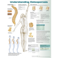 Understanding Osteoporosis Chart (52x70cm) With Special Rigid Lamination and Plastic Rollers