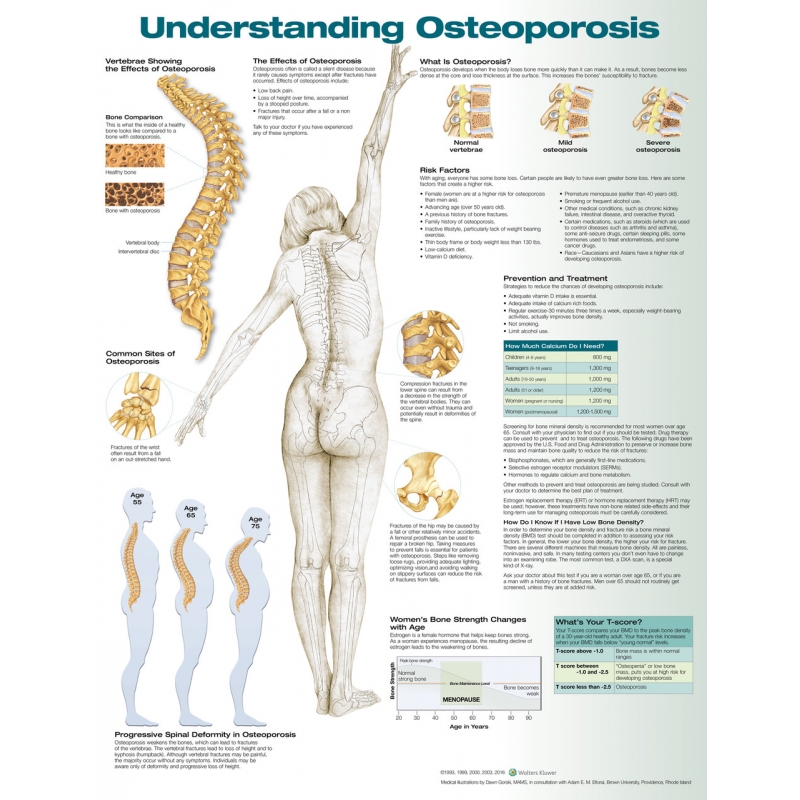 Understanding Osteoporosis Chart (52x70cm) With Special Rigid Lamination and Plastic Rollers