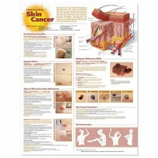 Understanding Skin Cancer Chart (52x70cm) With Special Rigid Lamination and Plastic Rollers