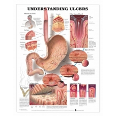 Understanding Ulcer Chart (52x70cm) With Special Rigid Lamination and Plastic Rollers