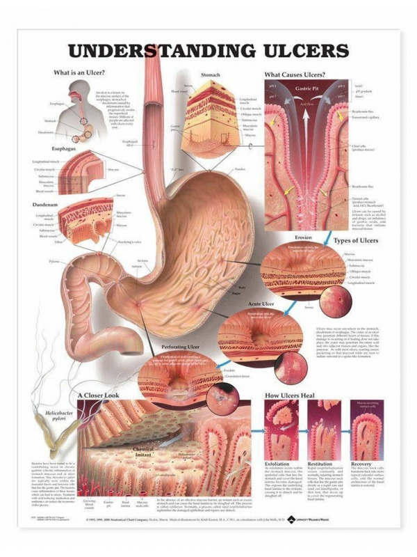 Understanding Ulcer Chart (52x70cm) With Special Rigid Lamination and Plastic Rollers