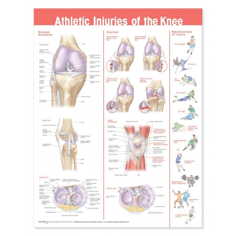 Athletic Injuries of Knee Chart (52x70cm) With Special Rigid Lamination and Plastic Rollers