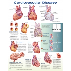 Cardiovascular Disease Chart (52x70cm) With Special Rigid Lamination and Plastic Rollers