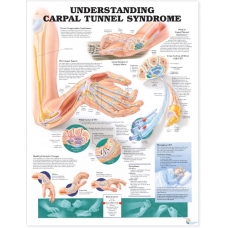 Carpal Tunnel Syndrome Chart (51x66cm) With Hard Backing, Aluminium Frame & Hanging Hooks