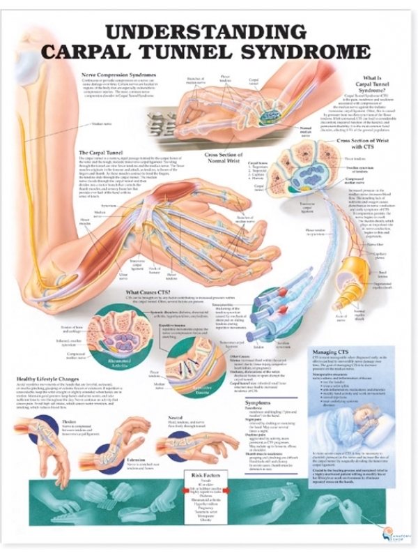 Carpal Tunnel Syndrome Chart (51x66cm) With Hard Backing, Aluminium Frame & Hanging Hooks