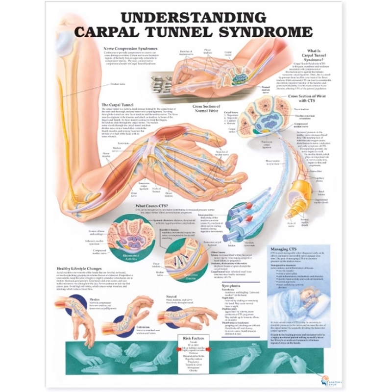 Carpal Tunnel Syndrome Chart (51x66cm) With Hard Backing, Aluminium Frame & Hanging Hooks