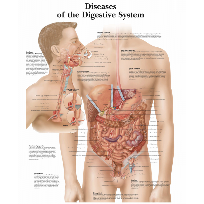 Diseases of the Digestive System Chart (52 × 70 cm, thick glossy paper)