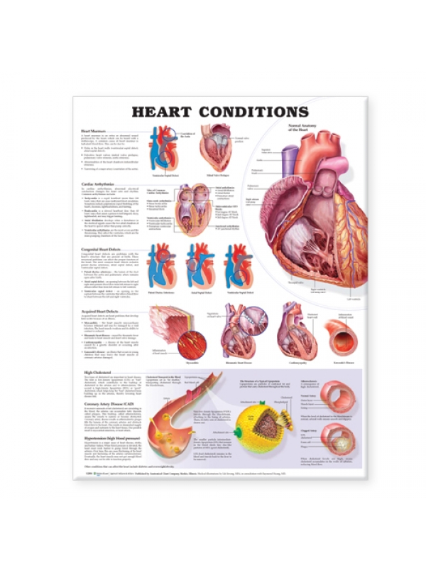 Heart Conditions Chart (52x70cm) With Special Rigid Lamination and Plastic Rollers