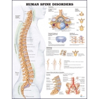 Osteoarthritis (OA) Educational Bundle | Knee & Spine 4 stage Degeneration Models + Spine Disorders & Knee Injuries Charts - Myaskro