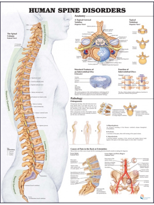 Human Spine Disorders Chart (51x66cm) With Hard Backing, Aluminium Frame & Hanging Hooks