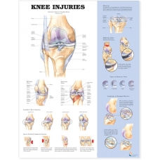 Knee Injuries Chart (51x66cm) With Hard Backing, Aluminium Frame & Hanging Hooks