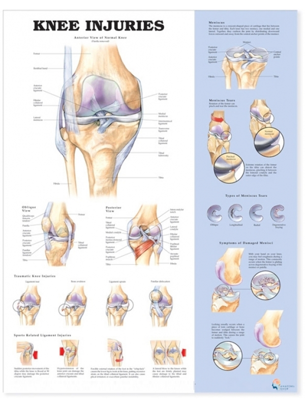 Knee Injuries Chart (51x66cm) With Hard Backing, Aluminium Frame & Hanging Hooks