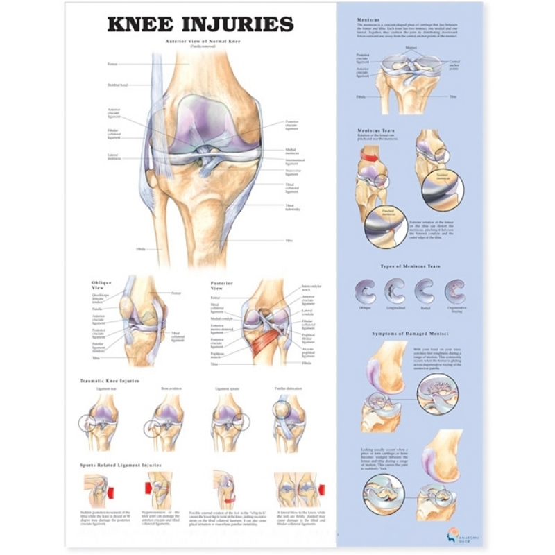 Knee Injuries Chart (51x66cm) With Hard Backing, Aluminium Frame & Hanging Hooks