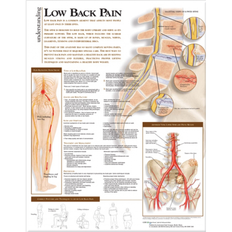 Low Back Pain Chart (52x70cm) With Special Rigid Lamination and Plastic Rollers