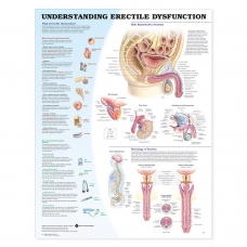 Understanding Erectile Dysfunction Chart (52x70cm) With Special Rigid Lamination and Plastic Rollers