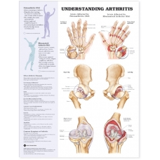 Understanding Arthritis (52x70cm) With Special Rigid Lamination and Plastic Rollers