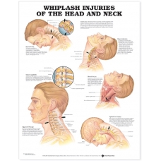 Whiplash and Injuries Of The Head and Neck Chart (52x70cm) With Special Rigid Lamination and Plastic Rollers
