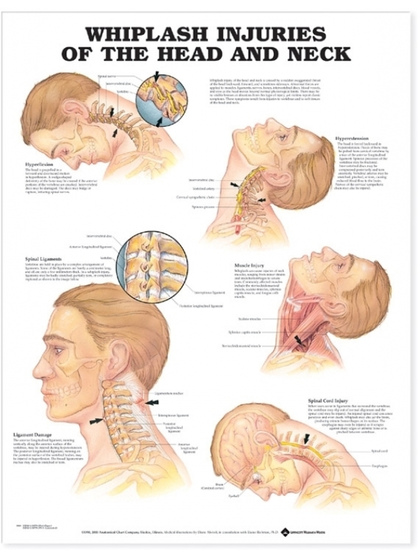 Whiplash and Injuries Of The Head and Neck Chart (52x70cm) With Special Rigid Lamination and Plastic Rollers