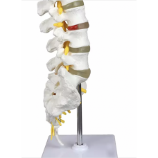 Lumbar Vertebrae. With Sacrum & Coccyx And Herniated Disc (Life-Size)