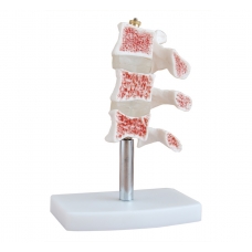 Myaskro - Cutaway Osteoporosis Anatomical Model