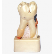 Dissected Model of Dental Disease