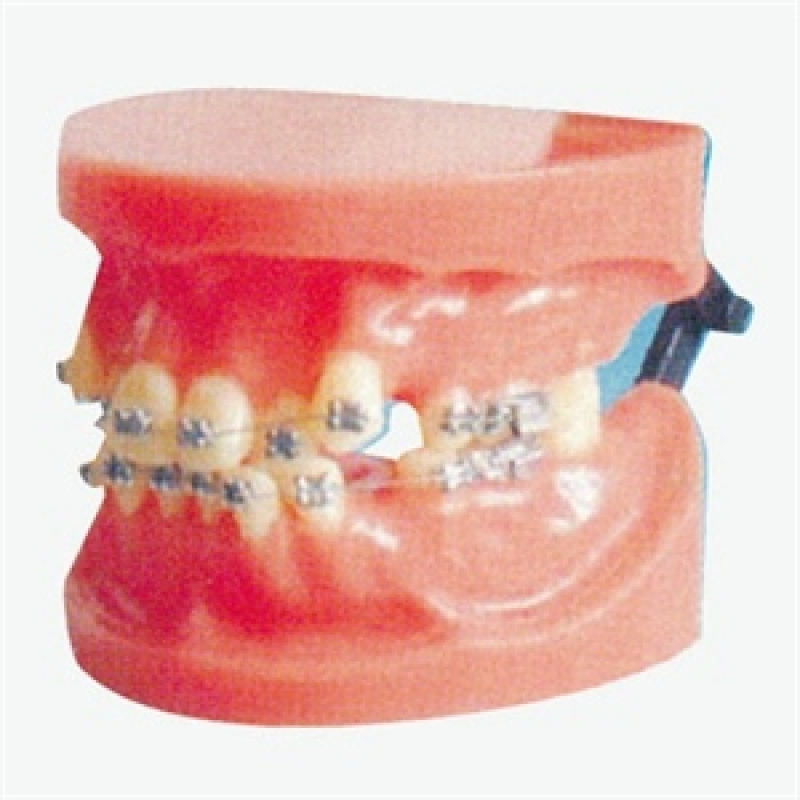 Fixed Orthodontic Model (Dislocation) by Myaskro