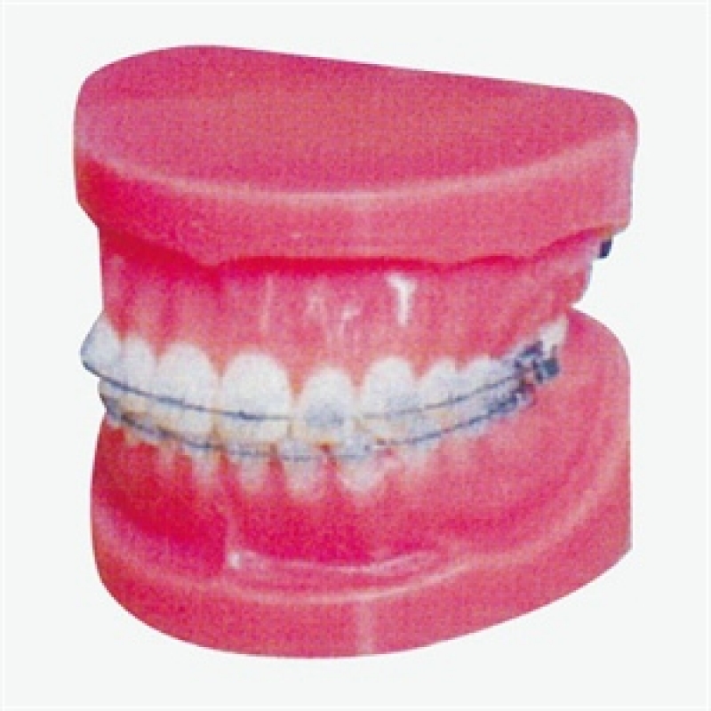 Fixed Orthodontic Model (Normal) by Myaskro