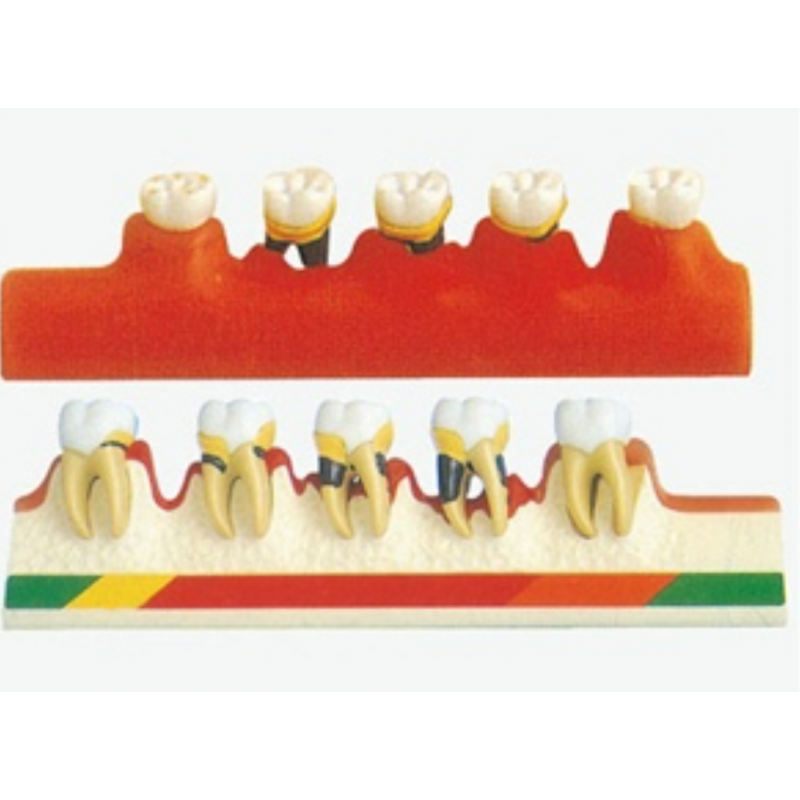 Periodontal Disease Model By Myaskro