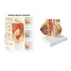 Breast Anatomy Model with Breast Disease Chart Bundle - Myaskro