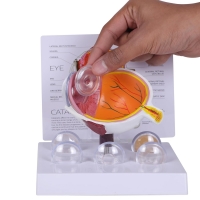 Eye Anatomy & Pathology Bundle with Cataract Model — MYASKRO