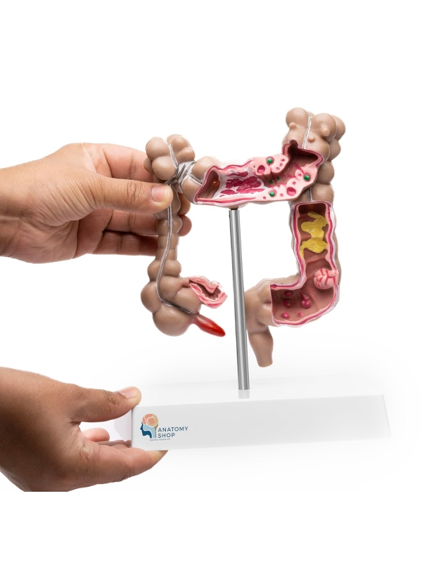 Myaskro - Colon Pathological Model Showing Various Pathologies