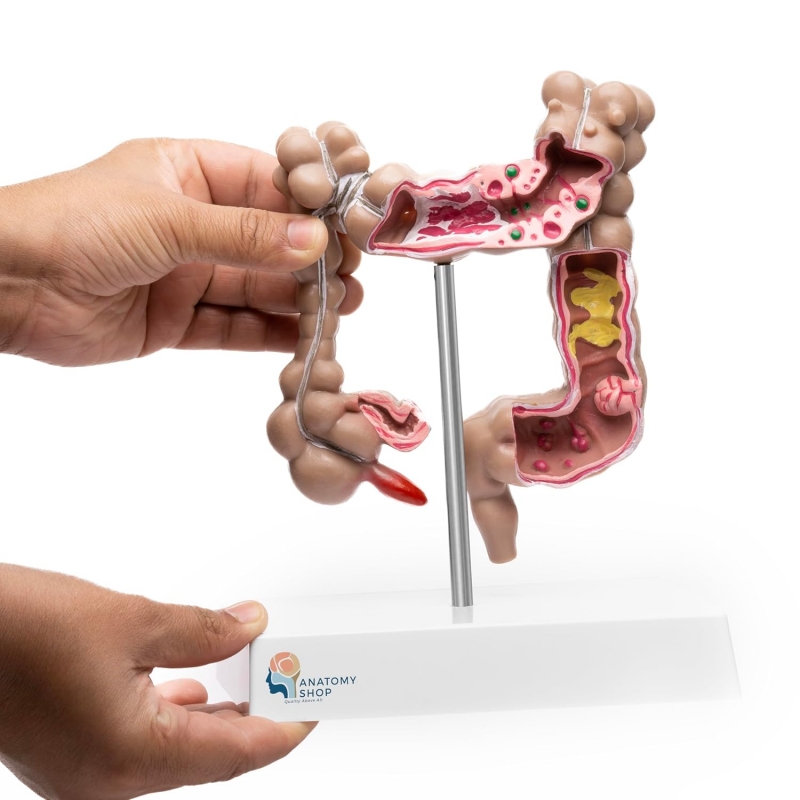 Myaskro - Colon Pathological Model Showing Various Pathologies