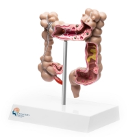 Myaskro - Colon Pathological Model Showing Various Pathologies