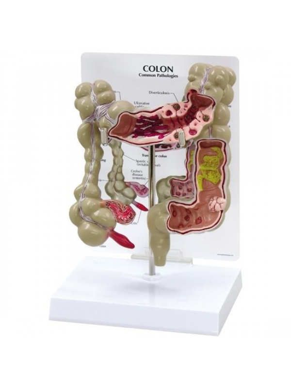 Myaskro - Colon Pathological Model Showing Various Pathologies