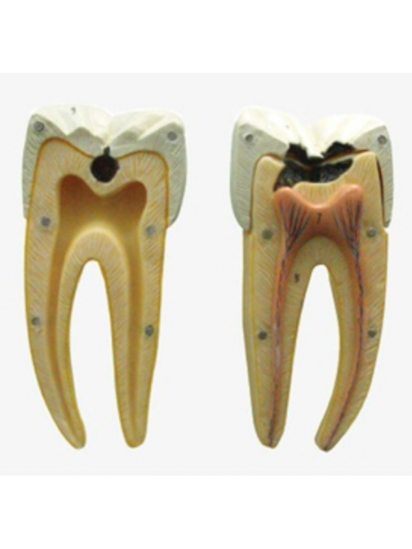 Dental Caries Model