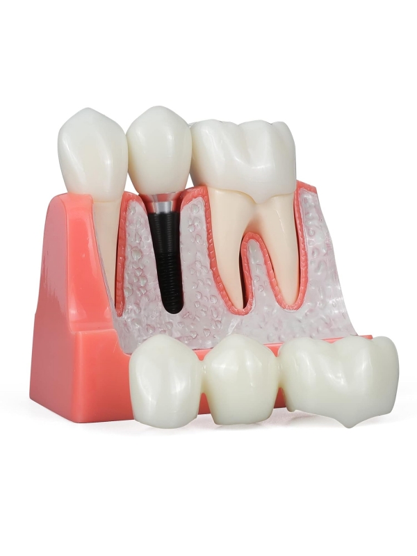 Dental Implant Model - Myaskro