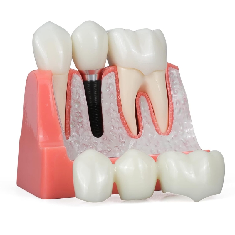 Dental Implant Model - Myaskro