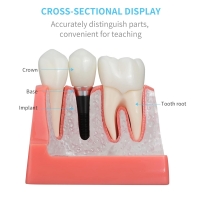 Dental Implant Model - Myaskro