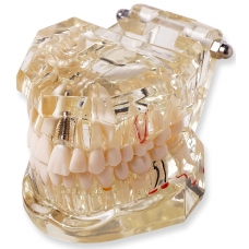 Dental Model With Pathologies To Demonstrate Dental Implants, Dental Diseases And Dental Treatments 