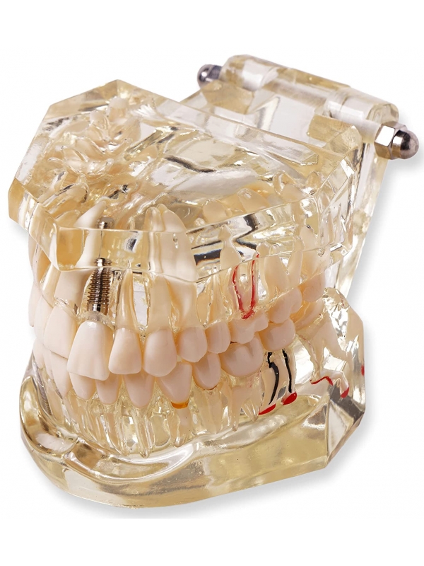 Dental Model With Pathologies To Demonstrate Dental Implants, Dental Diseases And Dental Treatments 